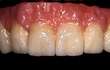Alveolar ceramics creates the effect of the natural - undulating gum