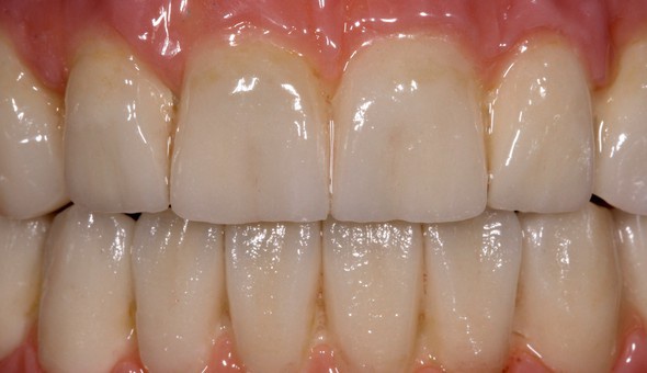 Ceramics offers the best possibilities for a natural smile