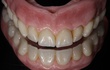 Tri-color acrylic creates the effect of true gums