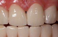 Coverage of dental enamel hypoplasia