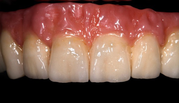 Alveolar ceramics creates the effect of the natural - undulating gum