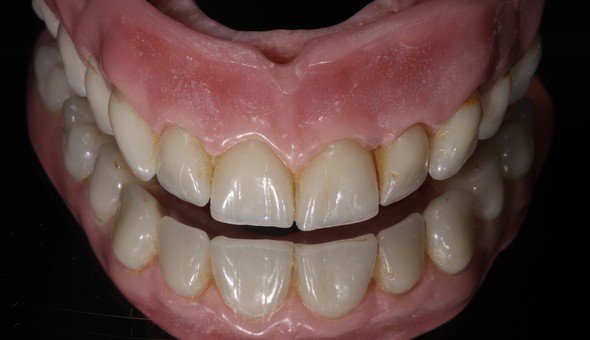Tri-color acrylic creates the effect of true gums