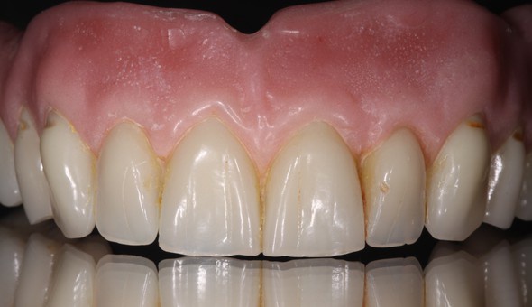 Die Zähne sind speziell beschichtet, um einen natürlichen Charakter verleihen