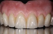 Die Zähne sind speziell beschichtet, um einen natürlichen Charakter verleihen