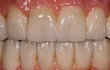 Ceramics offers the best possibilities for a natural smile